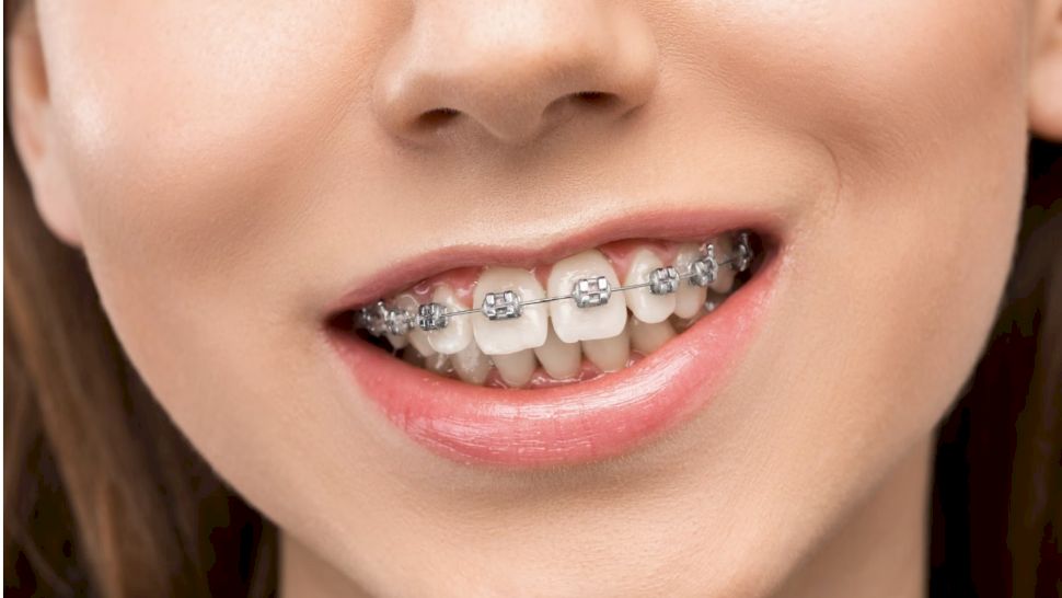 Cât de mult costă un aparat dentar